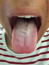 高1ですがこの舌苔って多いですか あと舌苔をなくす方法を教えてください Yahoo 知恵袋