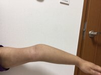 腕 についてです 私は小さい頃からこのように腕を伸ばすと曲がるので Yahoo 知恵袋