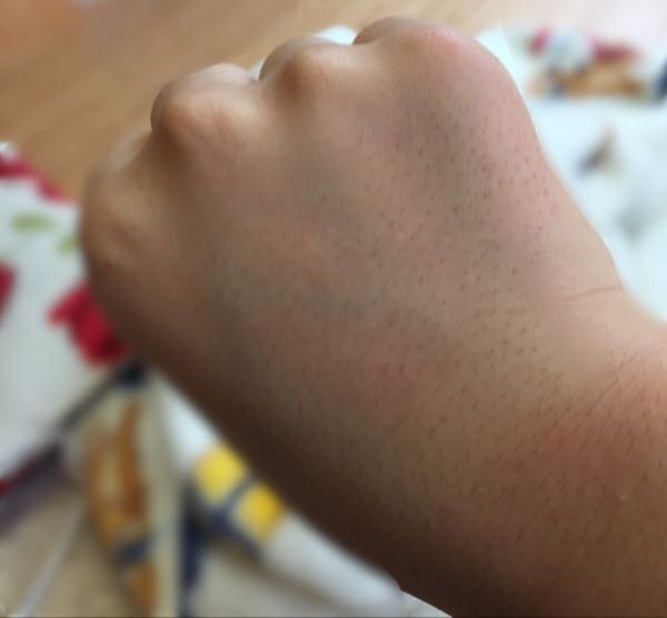 私は女性ですが手の毛穴がやばいです。どーしても治したいです。治せ... - 教えて！しごとの先生｜Yahoo!しごとカタログ