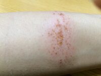 アルカリで腕を火傷しました 昨日火傷したんですが皮膚科に行く程なの Yahoo 知恵袋