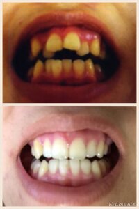 歯列矯正を終えてから リテイナーをサボっていたら 若干ですが 歯が動いてしま Yahoo 知恵袋