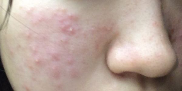 肌荒れが本当に辛いです どうかお力をお貸しください 閲覧いただきあり Yahoo 知恵袋