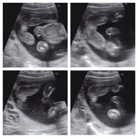 妊娠時 性別が途中で女の子から男の子に変わった方に質問です Yahoo 知恵袋