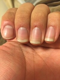 深爪を治したいです 現在25歳男性ですが 幼稚園の頃から爪を噛んでむしってし Yahoo 知恵袋