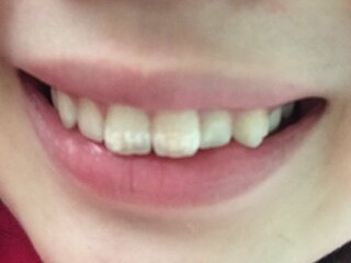 前歯にの白いものをとりたいのですが歯医者さんですぐに消してもらえるものなので Yahoo 知恵袋