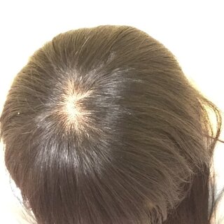 つむじ禿げに悩んでる高1女です 画像の通りです 禿げてますよね 友達に何度も Yahoo 知恵袋