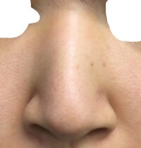 この鼻 かなり曲がってますか 毛穴は許して 鼻づまりも多いです 曲がって Yahoo 知恵袋