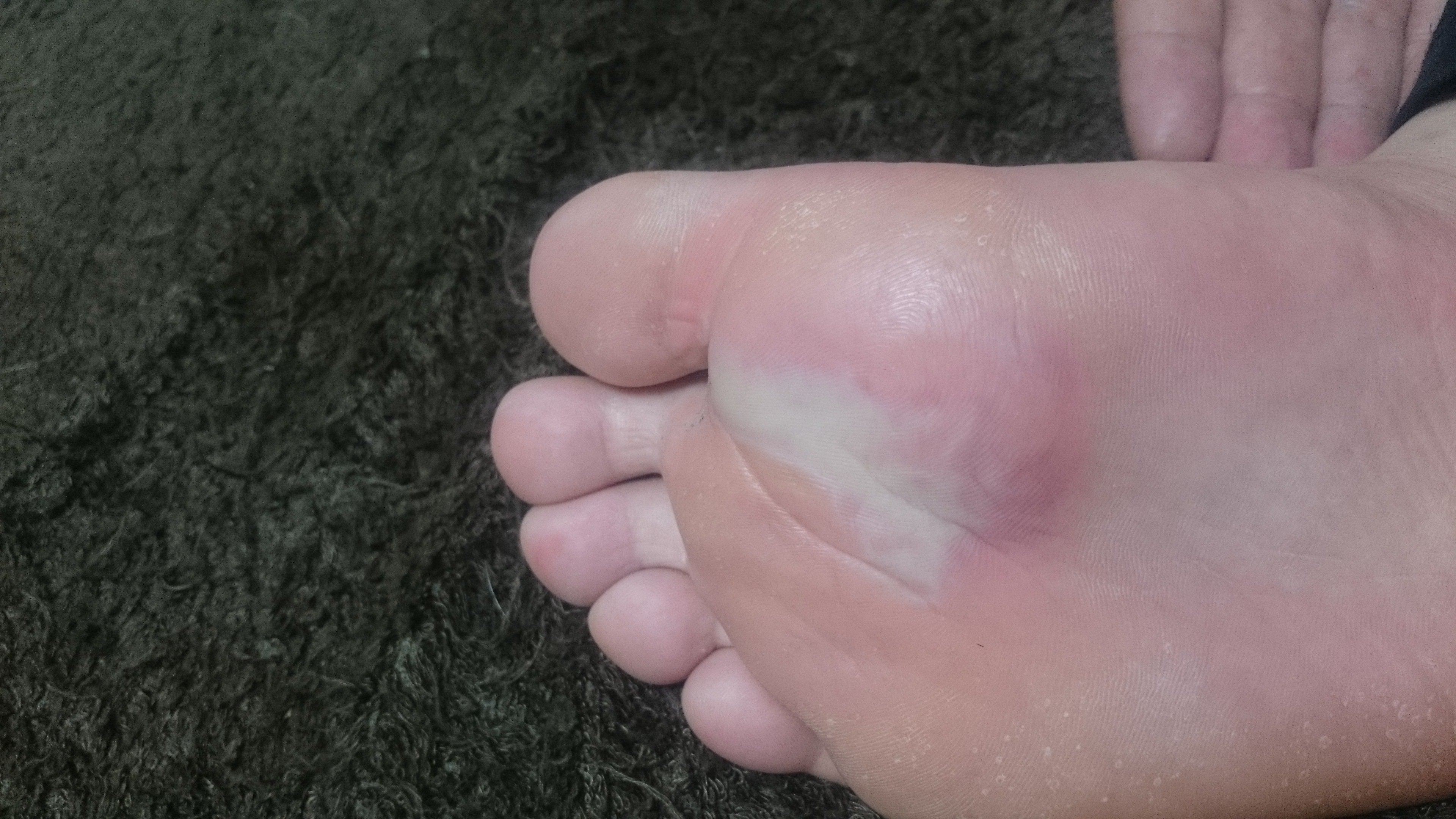 水虫 解決済みの質問 Yahoo 知恵袋