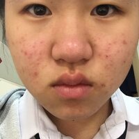 中１女子です ニキビに悩んでいます 画像のようなニキビは どうやっ Yahoo 知恵袋