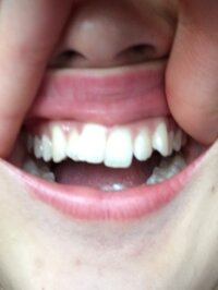 高校生です マウスピース矯正についての質問です 下の写真の歯並びです 上の歯 Yahoo 知恵袋