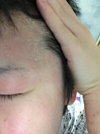 生え際おでこ乾燥の対策について アトピーですが 半年前ほどから生え Yahoo 知恵袋