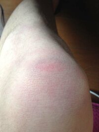 膝を強打しました 昨日急いで階段を登っていた際に転んで角で膝 Yahoo 知恵袋