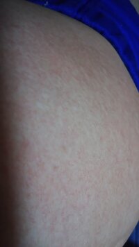 腹部に痒くも痛くもない湿疹 斑点のようなものができています 写真はお腹ですが Yahoo 知恵袋