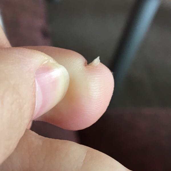 足の爪の形について 足の小指の爪の形がすごく反っています写真は爪を横か Yahoo 知恵袋