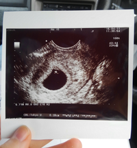 現在妊娠5週です エコー写真をみると胎嚢の大きさが同じ時期の方と違いす Yahoo 知恵袋