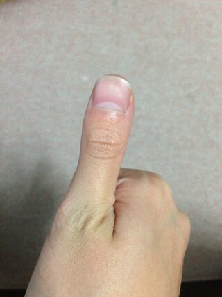 この指は マムシ指ですか マムシ指というものは遺伝なのですか 軽い短指 Yahoo 知恵袋
