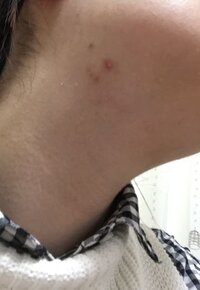 右のフェイスラインに重点的にニキビが出来ます 左は出来ません 熱くこもったも Yahoo 知恵袋