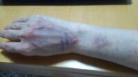 点滴がもれて青あざになってしましました 金曜日の朝に点滴をしたら 手の甲が青 Yahoo 知恵袋