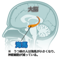 うつ病の人の、扁桃体は大きくなるけど、
海馬は損傷していることも分かってきたようだね？ 