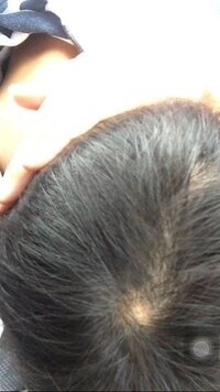 つむじが横に広がってるように見えます 薄毛でしょうか 質問者さんの様につ Yahoo 知恵袋
