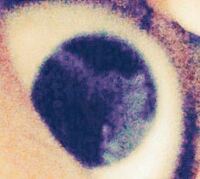 これは オンコセルカ症 寄生虫 ですか 目が すごく変な感じがしま Yahoo 知恵袋