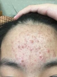 高校1年です ニキビについて悩んでいます 画像載せるのですが おで Yahoo 知恵袋