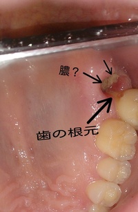 穴 食べかす 後 抜歯 抜歯 後