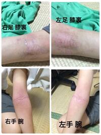 アトピーについてです 画像をつけますので 閲覧注意です 最近 アトピー Yahoo 知恵袋