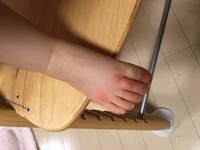 赤ちゃんの足なんですが これはダニ刺されですか 右足だけであれば 何か Yahoo 知恵袋