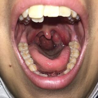 れる 扁桃 原因 腺腫