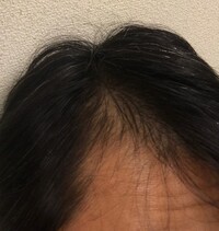 M字ハゲ隠したくて強引にパーマかけて何とかしようと試みてるんですが Yahoo 知恵袋