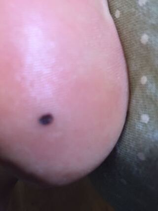 獲物 公平な 必要ない かかと ほくろ Cv Ono Jp