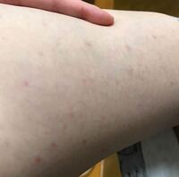 さっき トイレに行ったら太ももの内側に赤い斑点が出来ていました 明 Yahoo 知恵袋