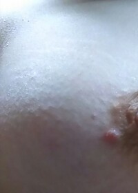 乳首の近くに赤いできもの があり 気になるので医者行きたいと思ってます Yahoo 知恵袋
