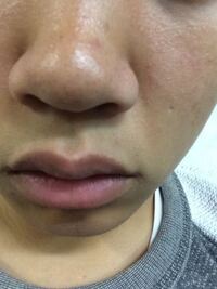 中３男子です 汚くてすいません 鼻に二つのニキビ跡 の様な Yahoo 知恵袋