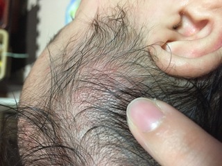 赤ちゃん 耳 の 後ろ しこり