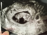 エコー写真の見方について 現在妊娠10週目です エコー写真を添付します この Yahoo 知恵袋