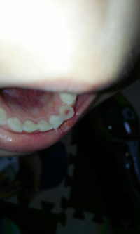 5歳の息子の歯なんですが 今日歯磨きをしていて見つけました Yahoo 知恵袋