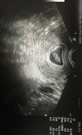 7週初期で胎芽１センチって小さいですか また 胎嚢はこのくらいの大 Yahoo 知恵袋