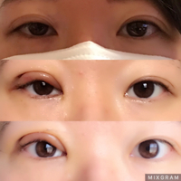 これは失敗なんでしょうか 右目眼瞼下垂の診断を受け 形成外科にて手術しました Yahoo 知恵袋