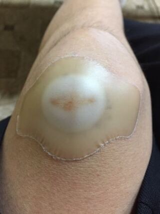 白く なる キズパワーパッド