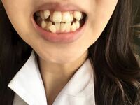 歯の画像あります 19歳の女です 歯並びの悪さに悩んでいます 歯の画 Yahoo 知恵袋