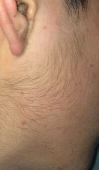 高校生です もみあげからあごにかけての髭が最近すごいです そればそるほど Yahoo 知恵袋