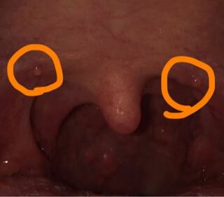 口蓋垂の両隣に違和感があり 見たらなにか水ぶくれみたいなものが できたり治っ Yahoo 知恵袋