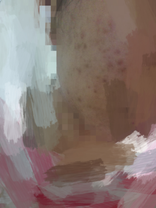 観覧注意 ニキビとニキビ跡に悩まされている16歳です 小４からニキビ Yahoo 知恵袋