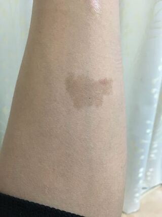 25歳男ですが この茶色のシミ は蒙古斑ですか Yahoo 知恵袋