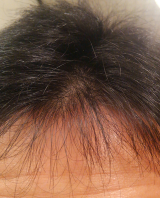 前髪の生え際の真ん中が薄く 頭皮が目立ちます もともと細く 密度の低い Yahoo 知恵袋