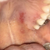 1週間ほど前から上顎に口内炎みたいなものが口の中にできていて あま Yahoo 知恵袋