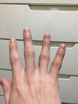 この指は変形性指関節症ですか 症状は何かありますか あとはリュウマチか Yahoo 知恵袋