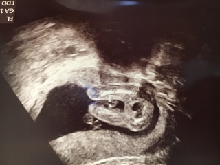 妊娠18週の者です このエコー写真で性別は女の子と断定できますか Yahoo 知恵袋